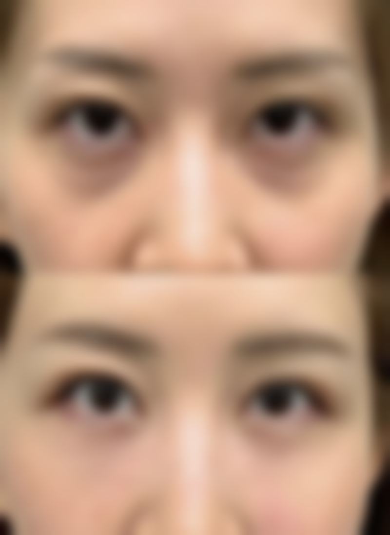 一、瘦脸针的基本原理与成效维持时长