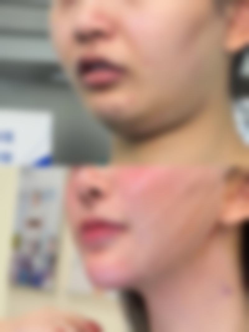 {黑眼袋冰敷有用吗？了解冰敷效果及方法，附实用图片为你揭晓答案 