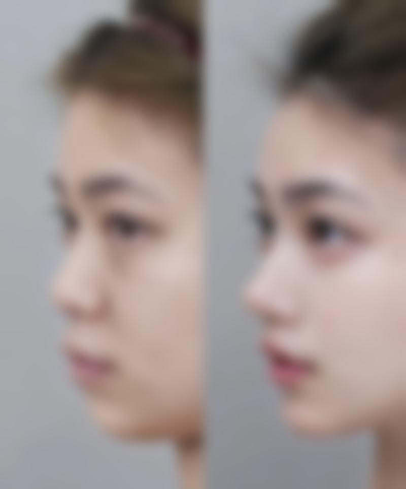 五、面部吸脂反弹的特殊情况