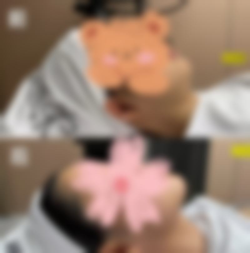 五、日常护理对脸上缝针疤痕修复的重要性