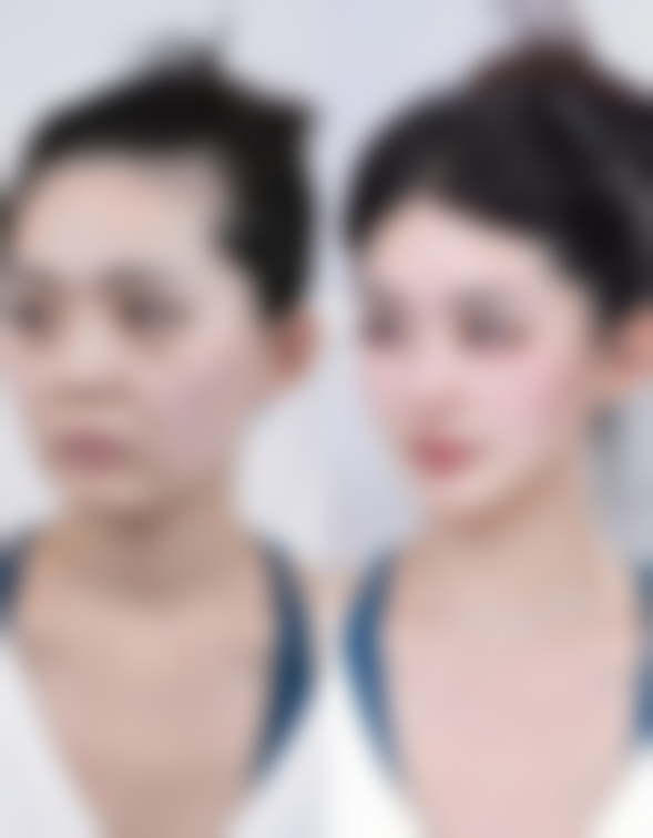 四、凸性疤痕的治疗方法