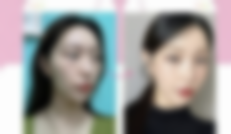 {脸上凹进去的疤痕能长平吗？了解不同情况及效果，附真实图片为你揭秘 