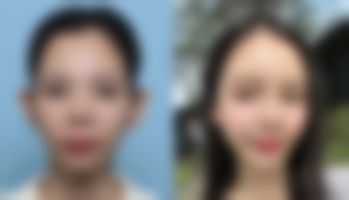 三、疤痕处理的注意事项