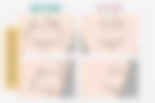 四、埋线与全切双眼皮手术的对比