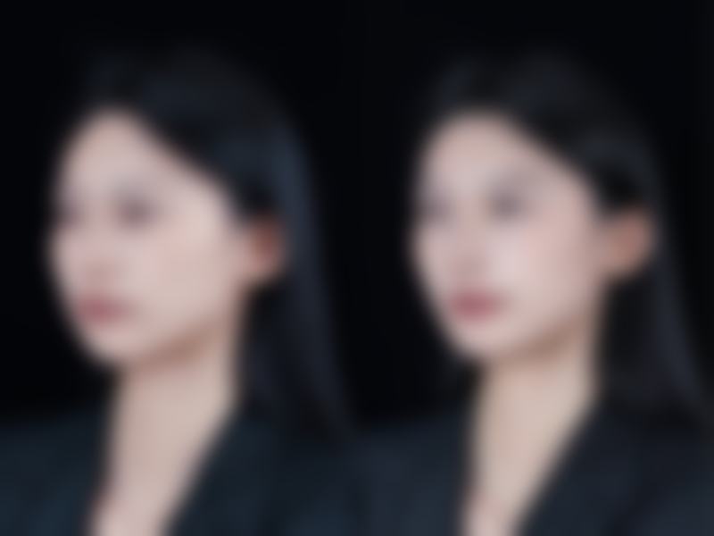 二、埋线双眼皮与大小眼