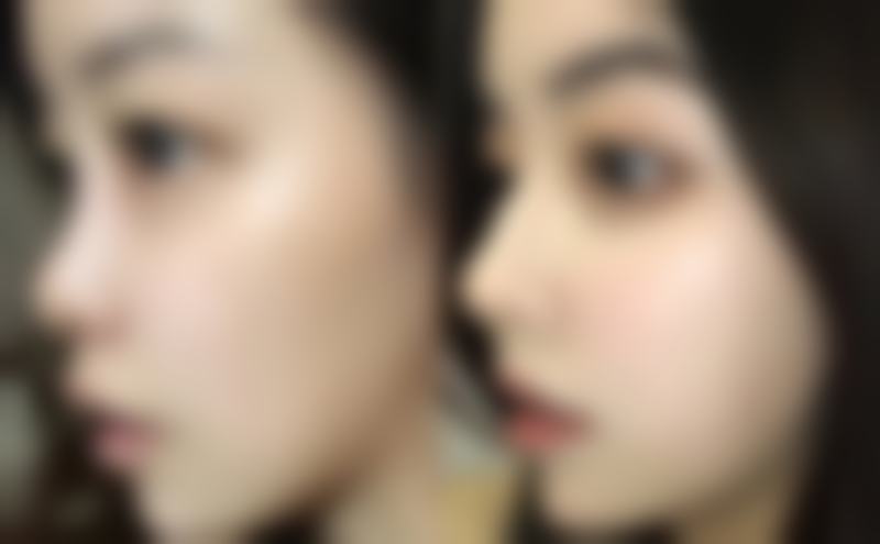 二、了解假体隆胸手术