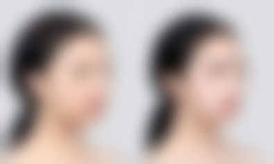 三、打瘦脸针的注意事项