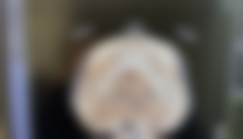 四、埋线双眼皮相关其他问题