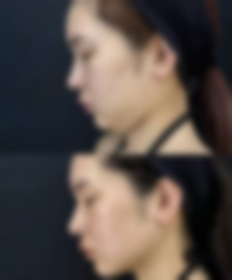{哪个隆鼻是永久的？硅胶、膨体植入隆鼻或能长期维持形态，你了解吗？ 