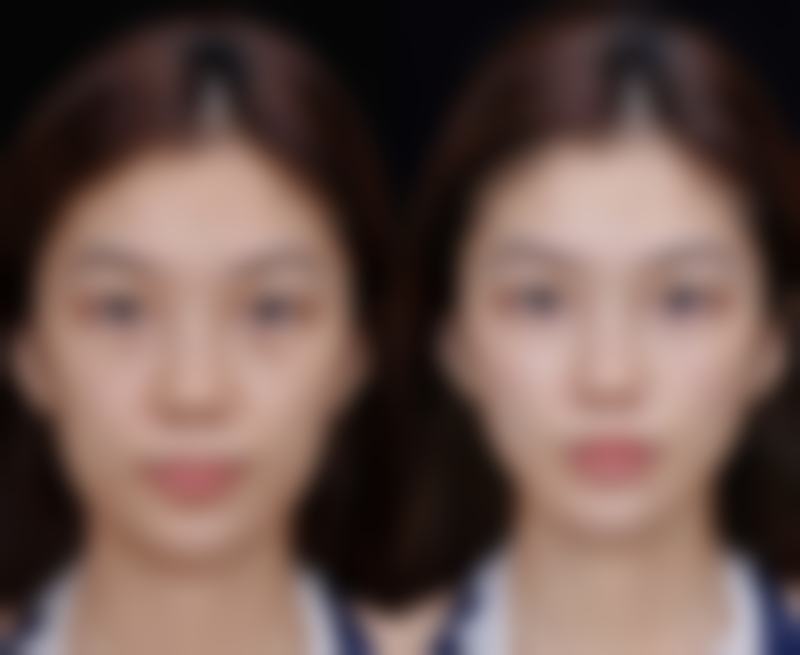 女生割双眼皮什么心态好？总结与思考