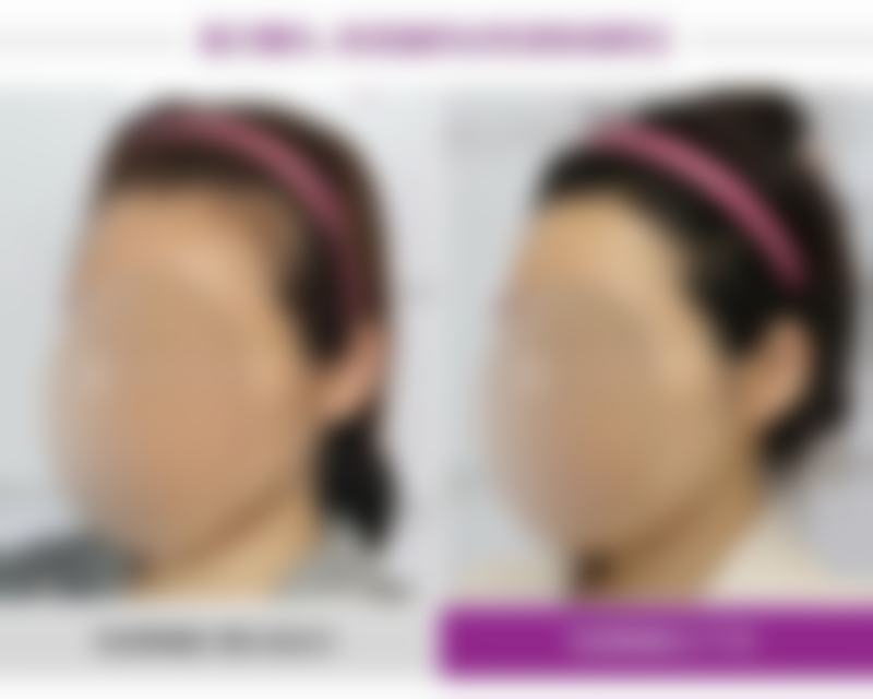 五、种植头发的优点