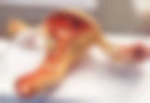 四、双眼皮术后眼皮外翻能修复吗之成功实例分享