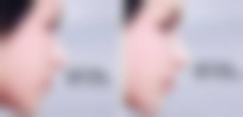 一、双眼皮术后眼皮外翻能修复吗之原因大揭秘