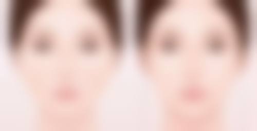 {双眼皮术后眼皮外翻能修复吗？看图片了解修复方法与成功案例