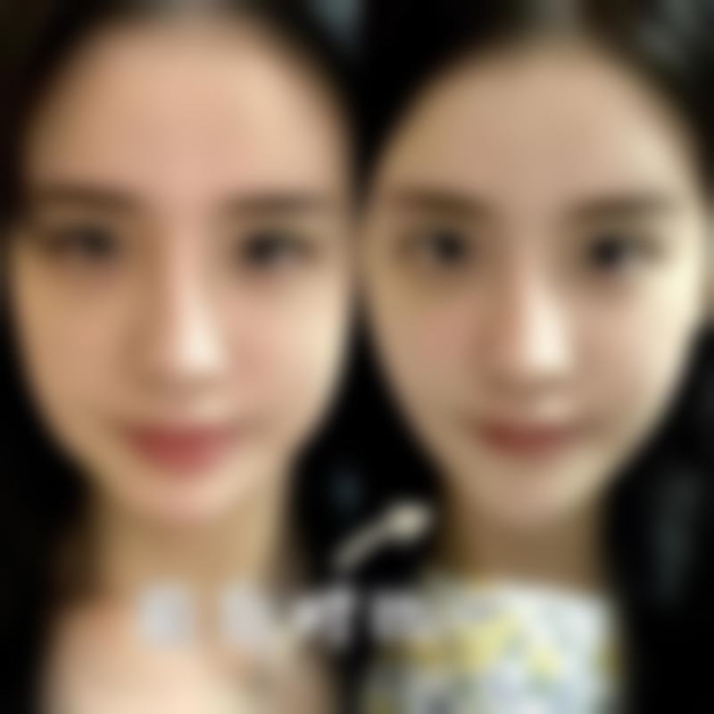 二、BSK隆鼻的美丽优势