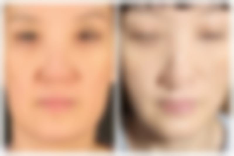 五、双眼皮术后眼皮外翻能修复吗之修复注意事项