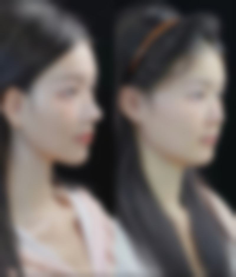 三、韩式双眼皮的手术方法