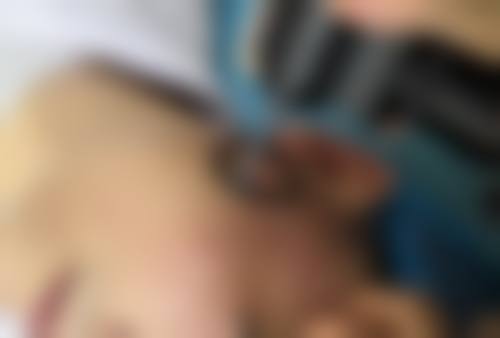 二、做隆鼻哪种材料比较好之膨体聚四氟乙烯