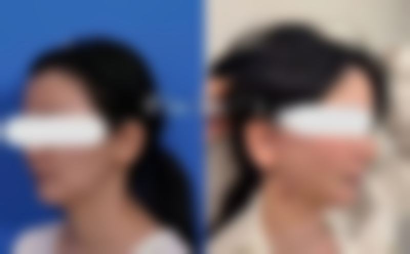 一、隆鼻25天吃海鲜的可行性