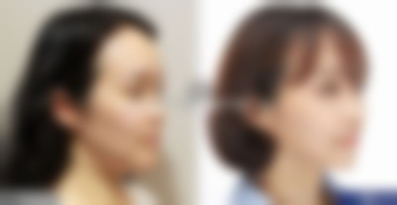 六、其他去眼袋方法对比