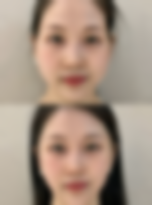 五、胶原蛋白打眼袋的注意事项