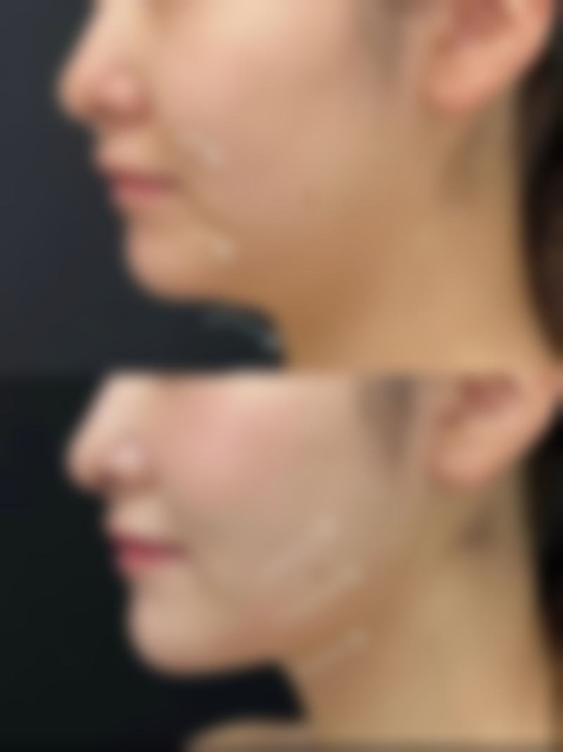 五、就医疗疗消除没睡好出现的眼袋