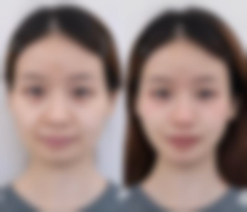 {做双眼皮手术会有疤痕吗？答案揭晓并附上真实图片让你直观了解情况 