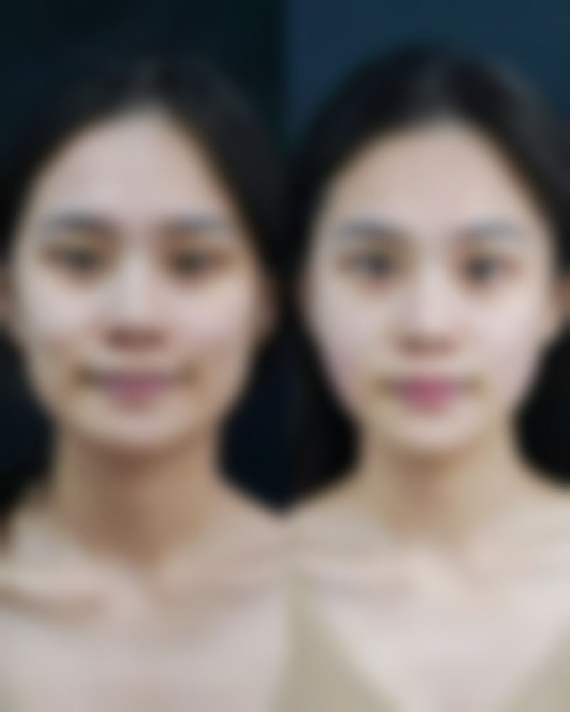 一、做眼袋对眼睛影响与手术方式的关系