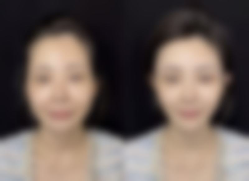 眼袋做了手术还会长吗?总结来说