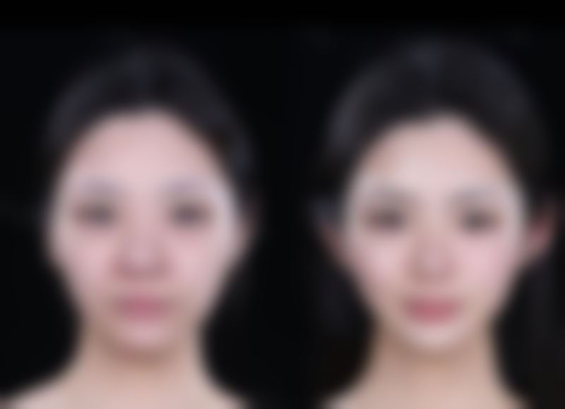 一、瘦脸针打多了会有副作用吗?常见副作用大盘点