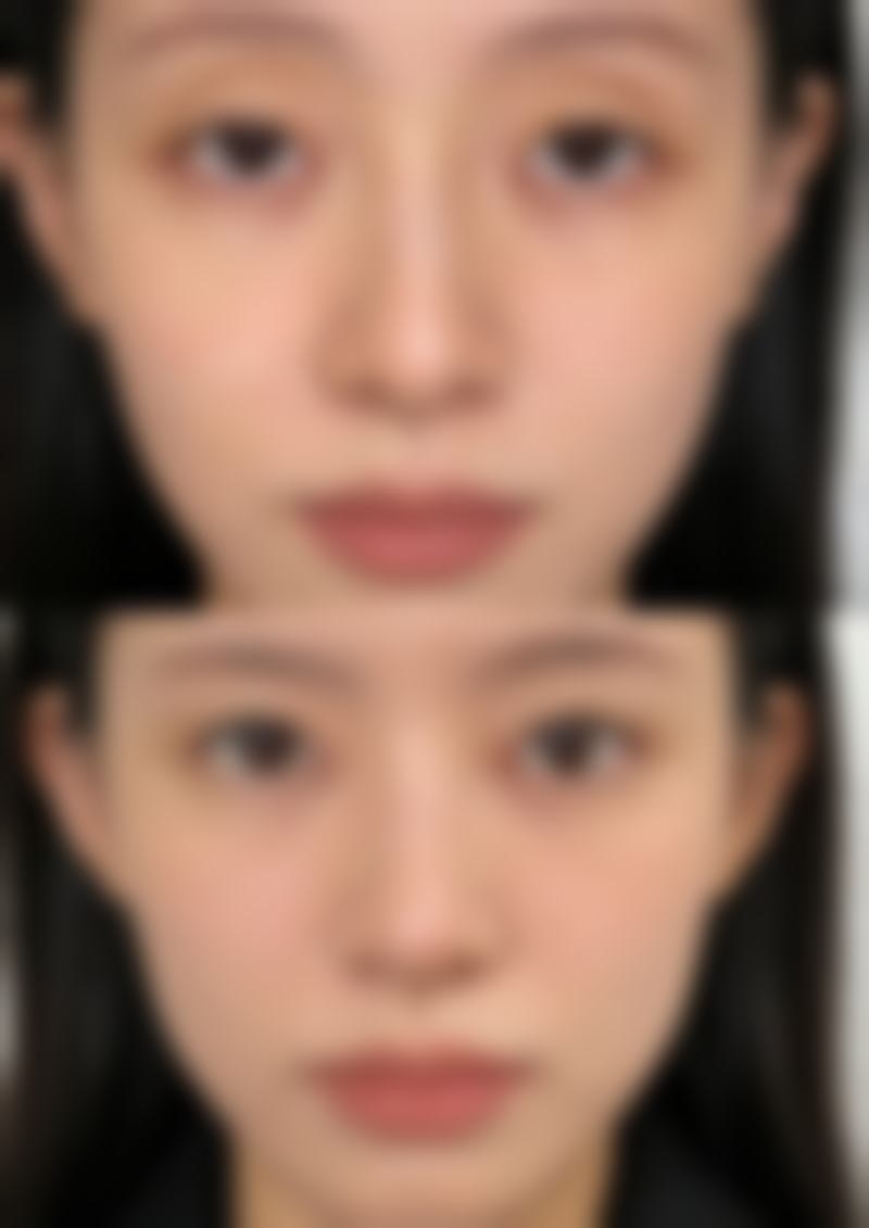 二、膨体材料在达拉斯隆鼻中的应用