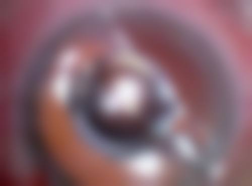 一、瘦脸针没打好之面部外观问题
