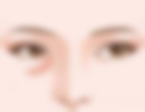 二、影响割的双眼皮是否留疤的因素