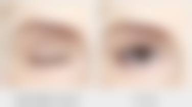 五、做完眼袋可以冰敷吗?不同眼袋手术方式的护理差异