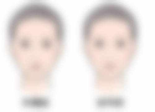 三、一般增生疤痕修复期间的注意事项