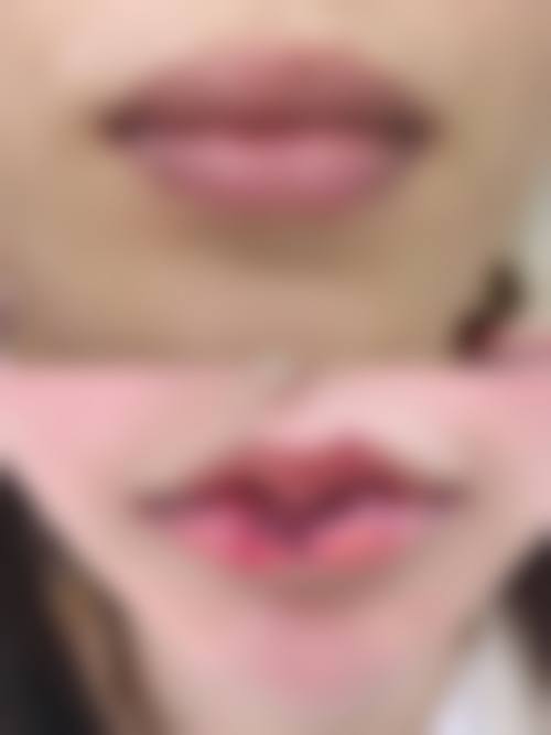八、临沂伊尔美纯韩整形美容医院真实的患者评价