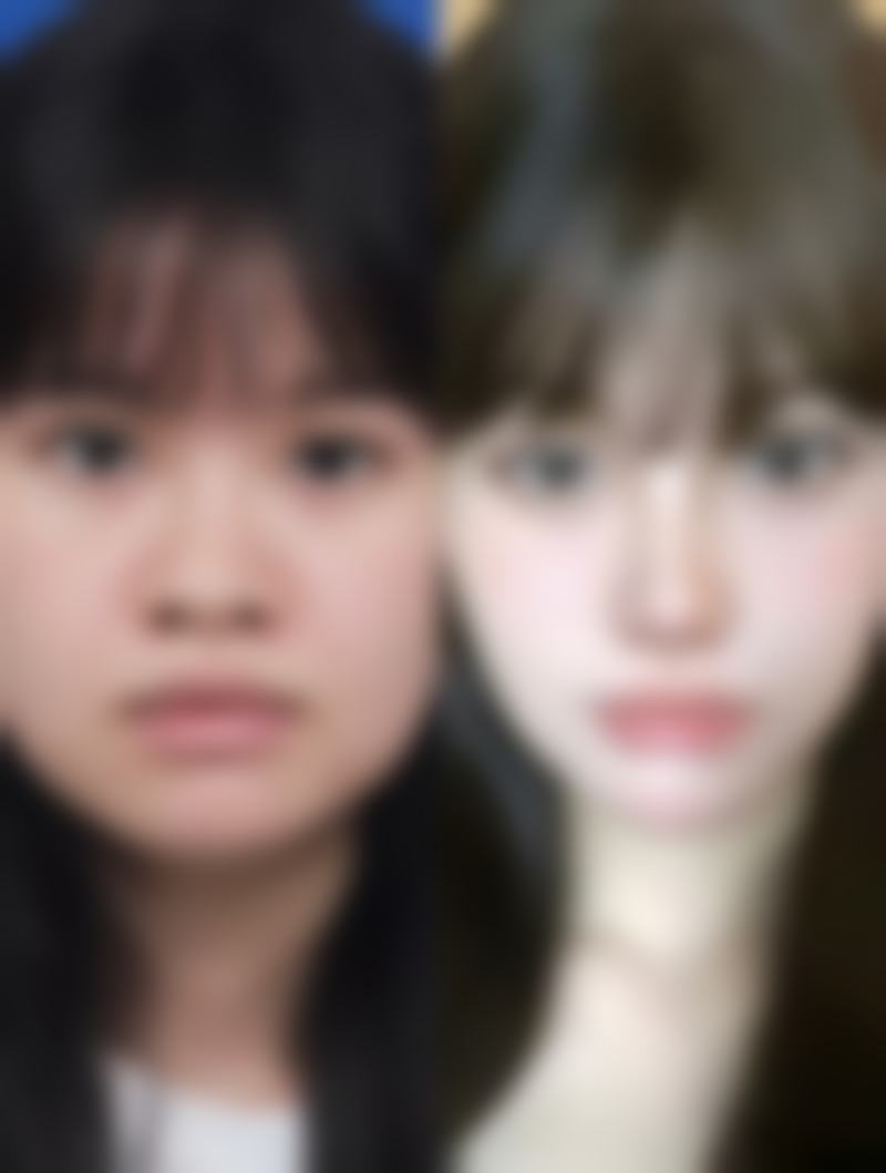 一、肋骨隆鼻拆线时间的常见范围