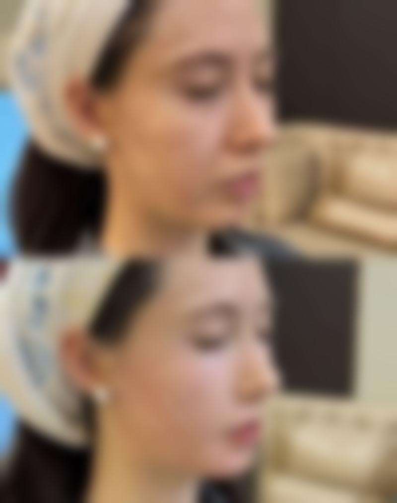 二、婴儿一只单眼皮一只双眼皮怎么办