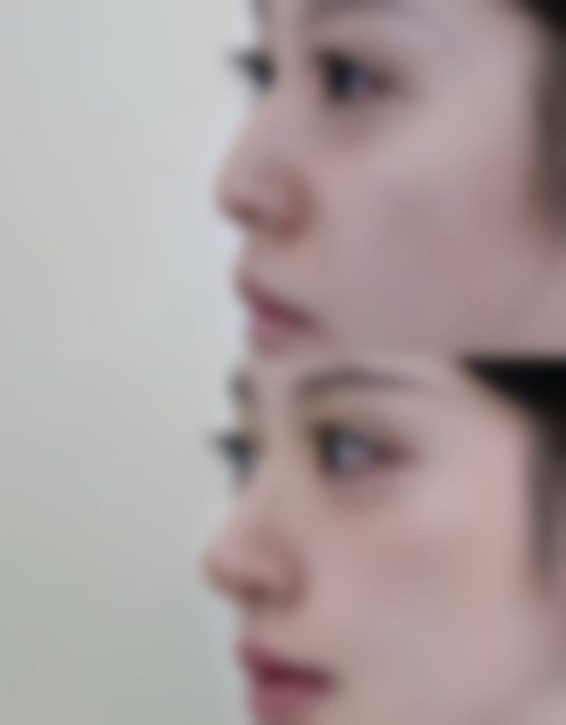 四、疤痕体质做双眼皮的术后护理要点