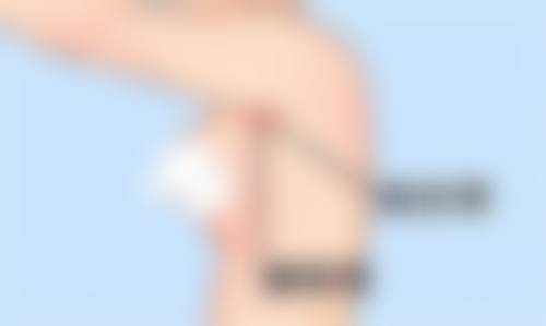 为什么割完双眼皮一边肿一边不肿呢？总结