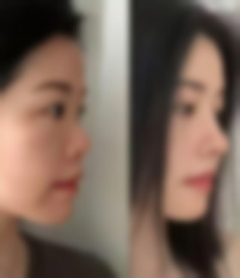 五、疤痕疙瘩包怎么去掉之冷冻治疗
