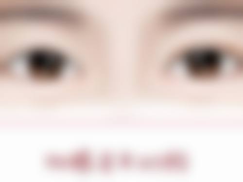 三、加快全切双眼皮淤血消失的方法