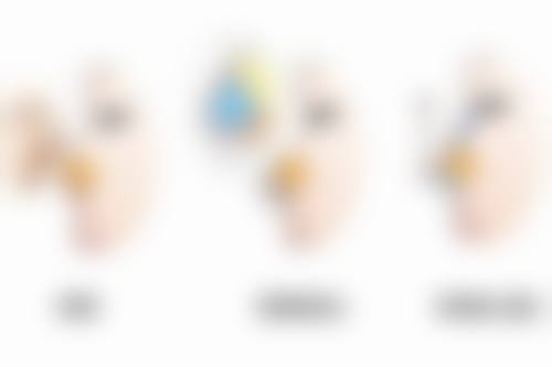 {假体隆胸后多久可以脂肪填充胸部？一般3至6个月但具体还需听医生建议 