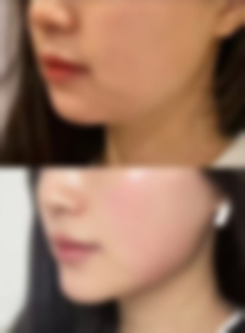 三、为啥不能马上进行脂肪填充