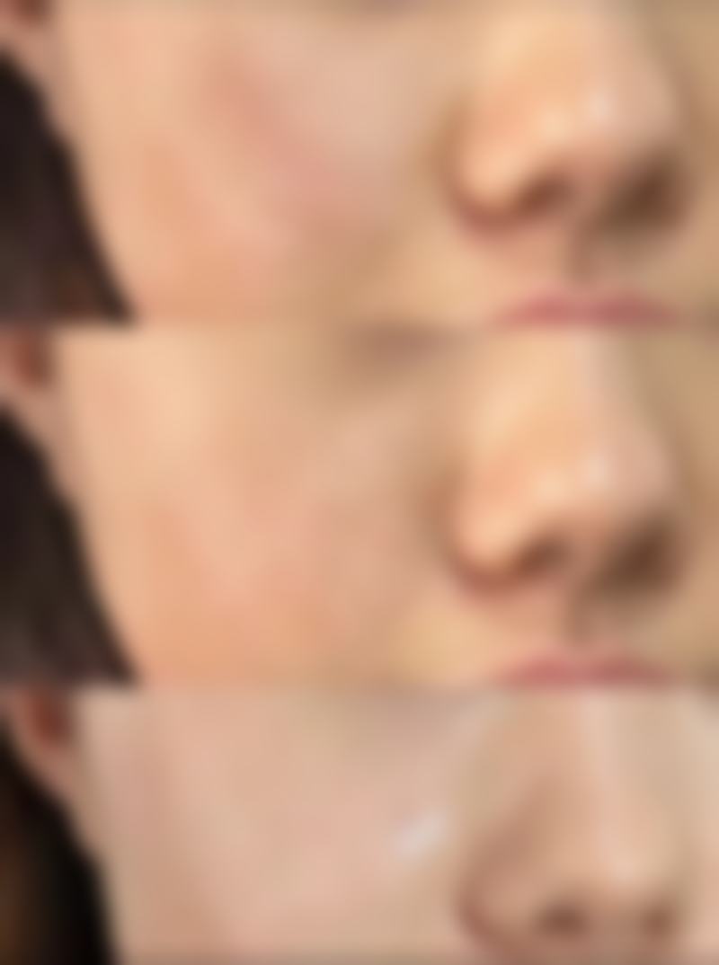 六、脂肪填充前的准备工作