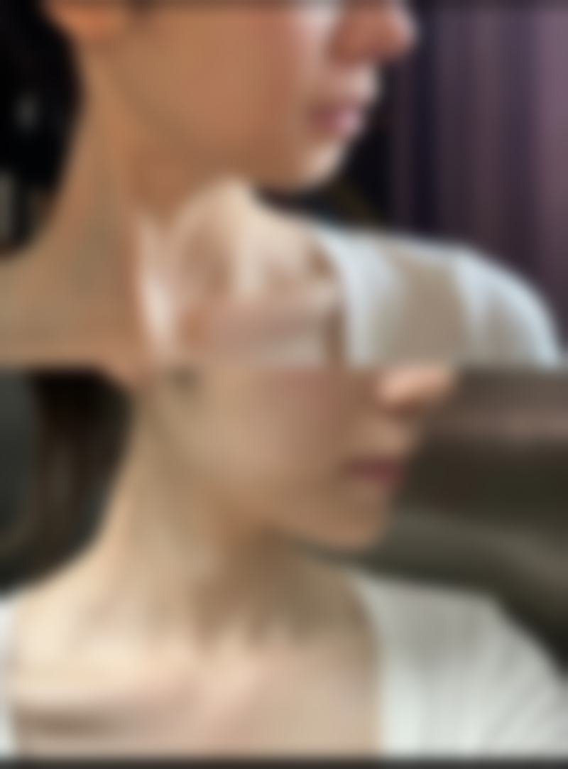 三、全切双眼皮的维持年限