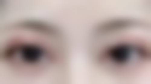 {隆胸取出假体一般需要多长时间？恢复时间又要多久？一文为你解答 