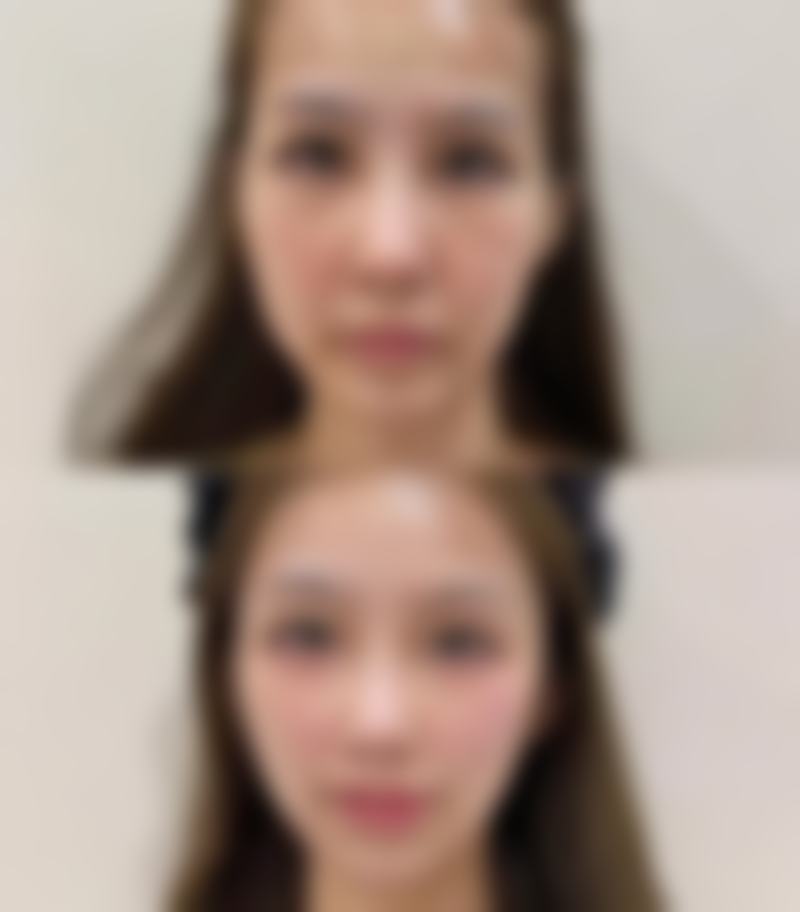 一、眼睛肿成双眼皮的常见原因