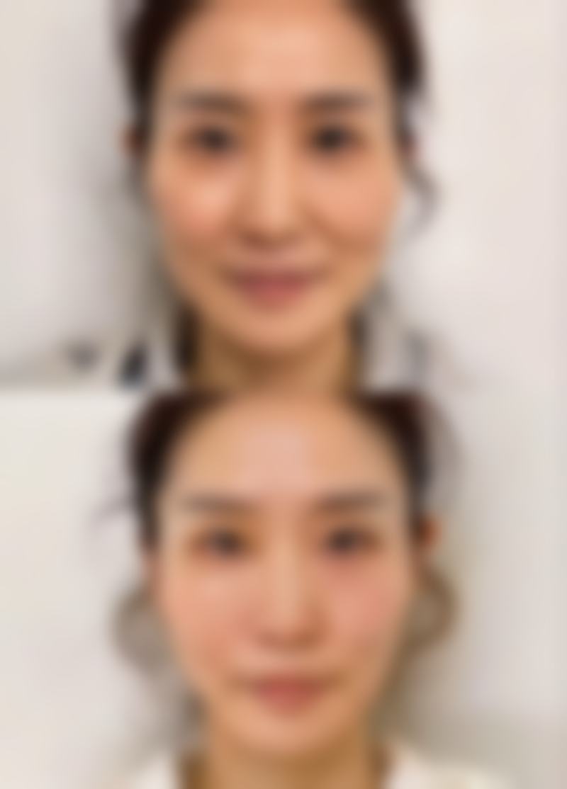 二、自体耳软骨隆鼻的危害