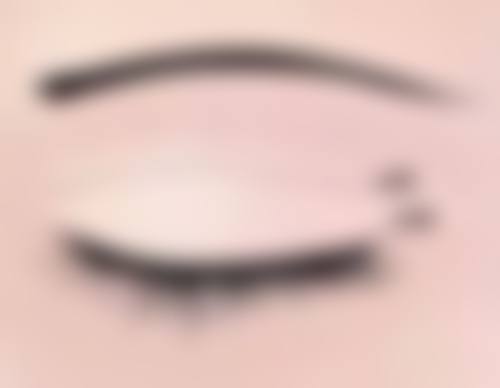 {隆鼻玻尿酸有什么坏处？局部发红肿胀、感染毁容等危害需警惕！ 